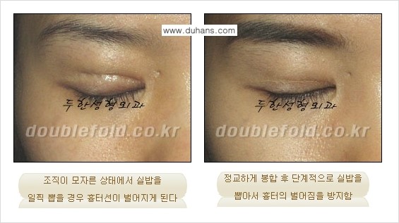 ​[두한성형외과] - [쌍꺼풀 재수술 클리닉의 특성과 자부심] 관련 이미지 5