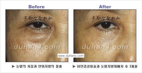 [두한성형외과의 상큼하고 환한 젊은 눈매완성] - [하안검 성형술 ①] 관련 이미지 3
