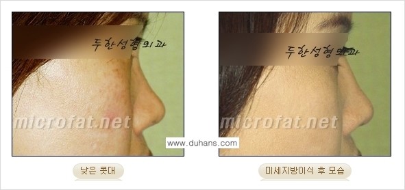 [두한성형외과 경쟁력 코성형] - [미세지방이식을 이용한 자연스러운 코성형 안내] 관련 이미지 13