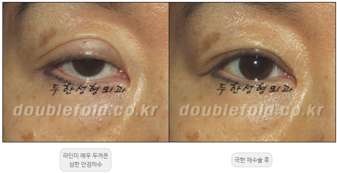 [Double Eyelid Surgery, Duhan Plastic Surgery] - [Extreme Revision Eye Surgery to Correct a Damaged Line] image 26