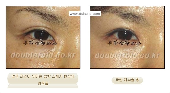 [두한성형외과 NO.1 경쟁력 눈성형] - [일반 쌍꺼풀 재수술과 극한 눈(쌍꺼풀) 재수술과의 차이점] 관련 이미지 15