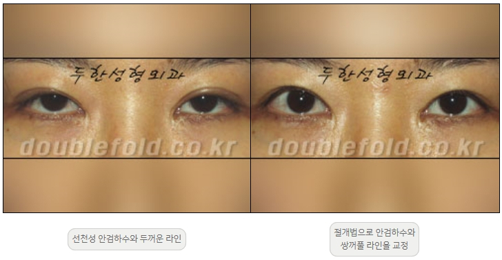 [Ptosis, Duhan Plastic Surgery] - [Sleepy-Looking Eyes, Ptosis Eye Correction] image 15