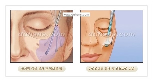 [두한성형외과 경쟁력 주름성형] - [눈썹거상, 앞볼처짐 개선의 엔도타인 리프팅] 관련 이미지 8