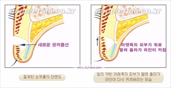 [두한성형외과 경쟁력 눈성형] - [쌍꺼풀 재수술에 대한 최선의 대안 제시] 관련 이미지 7