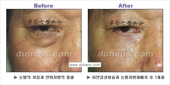 [두한성형외과의 상큼하고 환한 젊은 눈매완성] - [하안검 성형술 ①] 관련 이미지 8