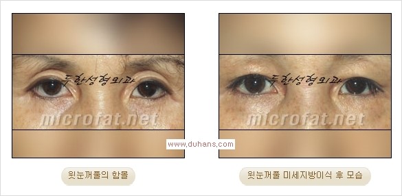 [두한성형외과 Dr. 컬럼] - [눈꺼풀의 지방이식] 관련 이미지 2