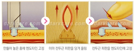 Duhan Plastic Surgery Combo Program - Dark Circles and Lifting image 20