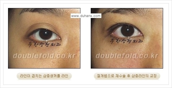 [두한성형외과 경쟁력 쌍꺼풀 재수술, 극한 재수술] - [삼중(세겹) 쌍꺼풀 라인의 교정 안내] 관련 이미지 6