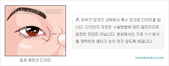 [두한성형외과 경쟁력 눈성형] - [몽고주름 제거수술, 앞트임 수술 안내] 관련 이미지 8