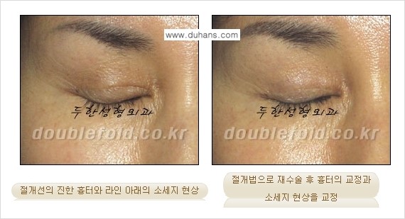 [두한성형외과 함께하는 아름다운 눈매로의 변신] - [흉터선이 진한 경우] 관련 이미지 3