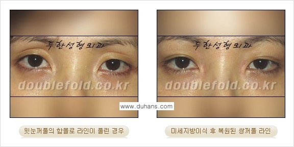 [두한성형외과 경쟁력 눈성형] - [미세지방이식으로 풀린 라인의 교정 방법 안내] 관련 이미지 6