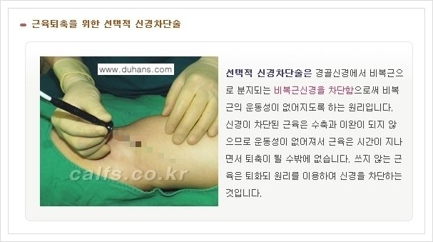 [두한성형외과 경쟁력 멀티종아리성형] - [나에게 맞는 종아리 시술 방법과 종류 안내 ①] 관련 이미지 5