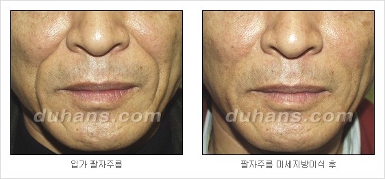 [두한성형외과 경쟁력 주름성형] - [세월의 흔적! 주름을 교정하는 여러 가지 교정 방법] 관련 이미지 27
