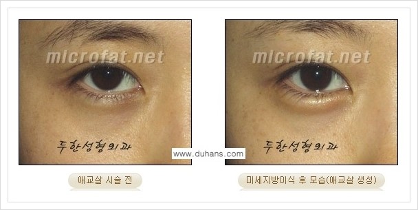 [두한성형외과 경쟁력 눈밑성형] - [눈밑 애교살 미세지방이식 안내] 관련 이미지 5