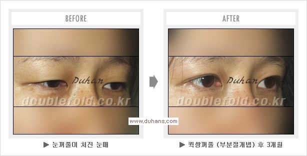 [두한성형외과 경쟁력 쌍꺼풀 재수술 리더] - [처진 눈을 자연스럽게 교정하는 부분절개법 안내] 관련 이미지 16