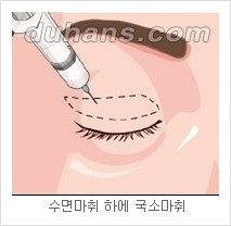 [두한성형외과 경쟁력 눈성형] - [젊은 눈매로의 복원 안검성형] 관련 이미지 2