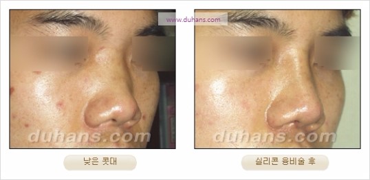 [두한성형외과 경쟁력 코성형 리더] - [자연스럽고 오똑한 콧망울! 코성형 방법]​ 관련 이미지 14