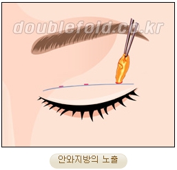 두한성형외과 쌍커풀재수술 - 삼중 쌍커풀 라인 교정 관련 이미지 10