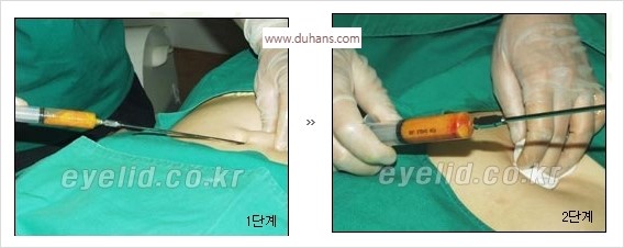 [두한성형외과 경쟁력 눈밑성형] - [눈밑 다크써클 수술 방법] 관련 이미지 6