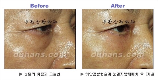[두한성형외과 경쟁력 동안성형 리더] - ​[미간주름, 이마주름, 안검성형, 이마거상술, 눈썹거상술] 관련 이미지 110