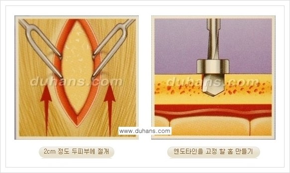 [두한성형외과 경쟁력 주름성형] - [엔도타인 리프팅 안내 ②] 관련 이미지 8