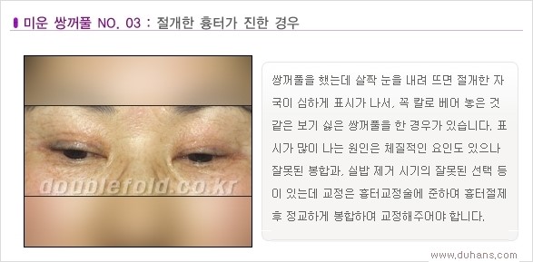 [두한성형외과 경쟁력 쌍꺼풀 재수술, 극한 눈재수술] - [Dr. 컬럼 - 재수술의 목표] 관련 이미지 6