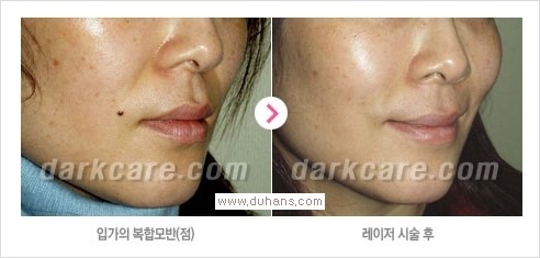 [두한성형외과 경쟁력 눈밑성형] - [다크써클 + 검버섯 레이저 콤비 프로그램 안내] 관련 이미지 9