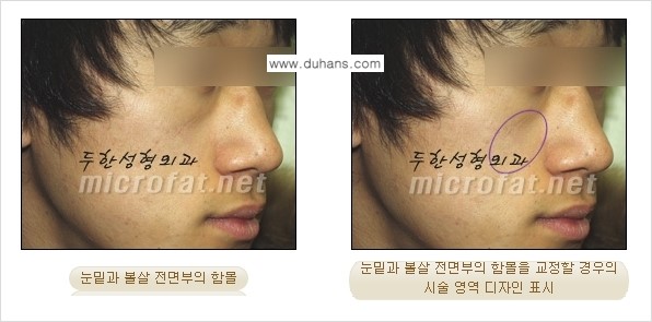 [두한성형외과의 경쟁력 미세지방이식] - [귀족수술과 인디언밴드 미세지방이식 안내 ①] 관련 이미지 8