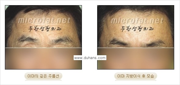 [두한성형외과의 경쟁력 있는 지방이식] - [이마 미세지방이식 2.] 관련 이미지 13