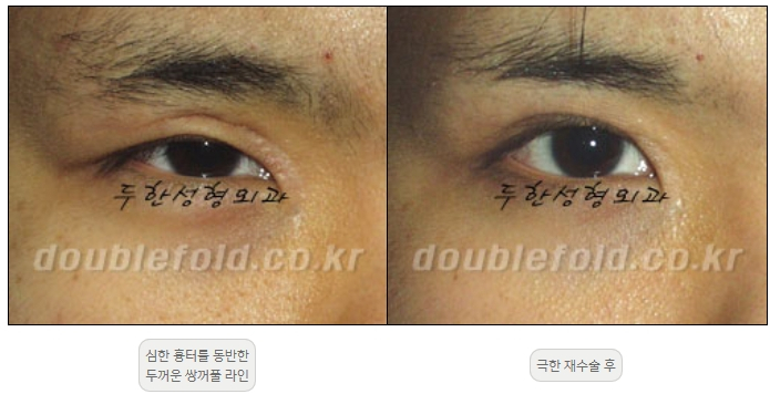[Double Eyelid Surgery, Duhan Plastic Surgery] - [Extreme Revision Eye Surgery to Correct a Damaged Line] image 19