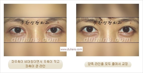 [두한성형외과 경쟁력 눈성형] - [나에게 맞는 어울리는 쌍꺼풀 라인] 관련 이미지 30