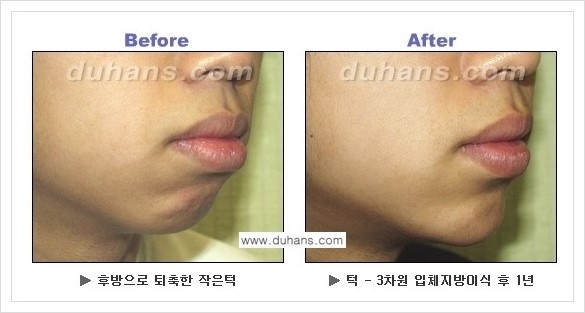 [두한성형외과 경쟁력 미세지방이식] - [아름다운 얼굴선 - 무턱, 오목턱, 비대칭턱 지방이식 안내] 관련 이미지 11
