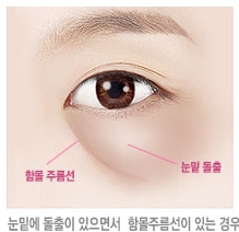 두한성형외과 눈밑수술 - 다크서클 수술 전후 관리 안내 관련 이미지 103