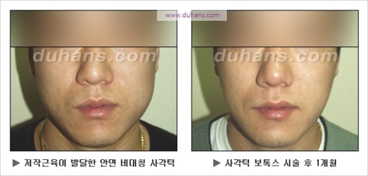[두한성형외과 경쟁력 안면윤곽 성형 리더] - [완변한 V 라인! 턱 미세지방이식, 볼살 미세지방이식, 사각턱 보톡스 안내] 관련 이미지 40