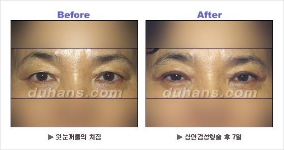 [두한성형외과 경쟁력 안검성형] - [상큼하고 환한 눈매의 완성 상안검 성형술 안내] 관련 이미지 10