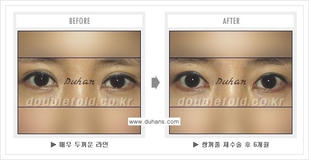 [두한성형외과 경쟁력 쌍꺼풀 재수술] - [여러번의 쌍꺼풀 재수술로 인한 흉살이 두터운 경우 안내] 관련 이미지 5