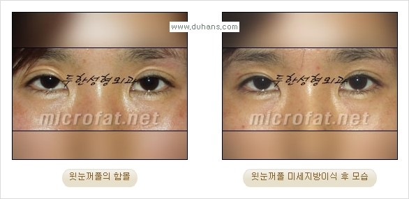 [두한성형외과 경쟁력 미세 #지방이식 ] - [윗 #눈꺼풀함몰, #꺼진눈꺼풀, #눈위지방이식, #눈위함몰] 관련 이미지 14