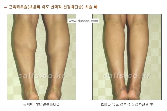 [두한성형외과 경쟁력 멀티종아리성형] - [굵은 알통 종아리 수술 안내 2.] 관련 이미지 6