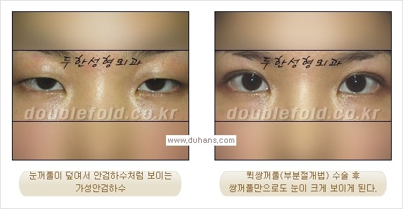[두한성형외과 경쟁력 쌍꺼풀 재수술, 극한 눈재수술] - [안검하수 검사 및 수술방법 안내] 관련 이미지 20