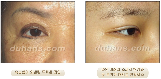 [Duhan Plastic Surgery Double Eyelid Revision] - [Causes of Revision Failure and Common Questions] image 1