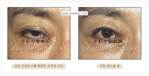 [두한성형외과 경쟁력 쌍꺼풀 재수술] - [극한의 상태에서 쌍꺼풀 재수술 안내 ①] 관련 이미지 6
