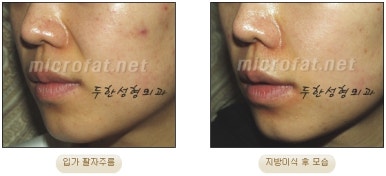 [Duhan Plastic Surgery Face Fat Grafting] - [Reducing Mouth Corners Wrinkles and Nasolabial Folds] image 12