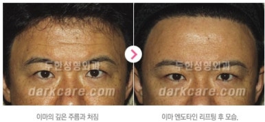 [눈밑수술 두한성형외과] - [다크서클 콤비프로그램] 관련 이미지 145