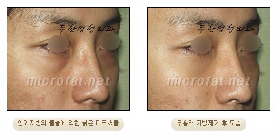 [두한성형외과 쌍커풀수술] - [눈성형 방법에 대한 자주하는 질문과 답변] 관련 이미지 185