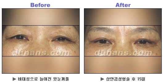 [두한성형외과 안검성형] - [상안검, 하안검] 관련 이미지 8