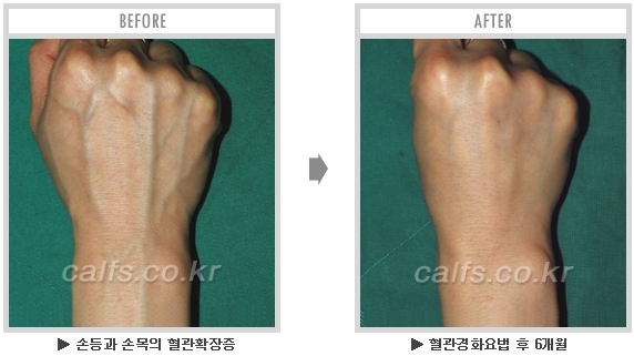 [종아리성형 두한성형외과] - [종아리수술에 대한 자주하는 질문과 답변 모음] 관련 이미지 48