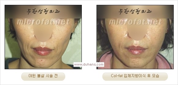 [두한성형외과 경쟁력 지방이식] - [두한 자가지방이식 클리닉 안내]​ 관련 이미지 46