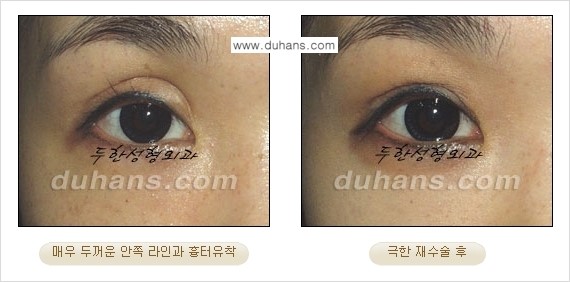 [두한성형외과 성형 FOCUS] - [정상적인 눈매로의 복원 극한재수술 경우 ②] 관련 이미지 3