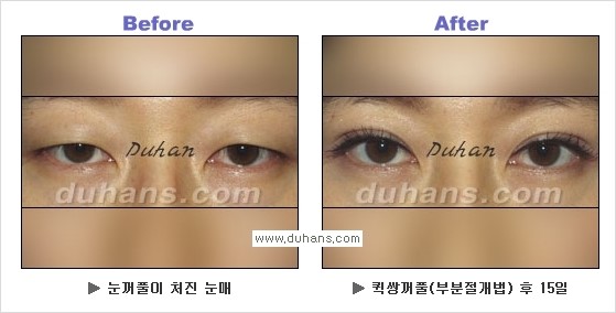 ​[두한성형외과 경쟁력 눈성형] - [자연스럽고 아름다운 쌍꺼풀의 기준] 관련 이미지 23