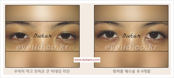 [두한성형외과 경쟁력 눈성형] - [절개법, 매몰법의 수술 방법] 관련 이미지 12